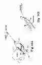 Fig. 45 - Systems, implants, tools, and methods for treatments of pelvic conditions
