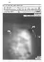 Fig. 01 - Marking system for computer-aided detection of breast abnormalities