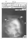 Fig. 06 - Marking system for computer-aided detection of breast abnormalities