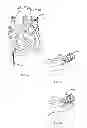 Fig. 04 - METHOD AND DEVICE FOR TREATMENT OF ARRHYTHMIAS AND OTHER MALADIES
