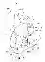 Fig. 05 - Biliary decompression and anastomosis stent