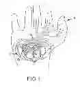 Fig. 02 - Systems and methods for treatment of compressed nerves