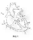 Fig. 02 - System and method for transapical access and closure
