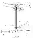 Fig. 35 - System and method for transapical access and closure