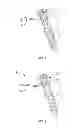 Fig. 02 - ATTACHMENT MECHANISM FOR MATERIAL AND BONE
