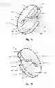 Fig. 02 - Suture clip