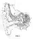Fig. 02 - Fixture and Removal of Hearing System External Coil