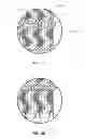 Fig. 09 - Esophageal stent with valve