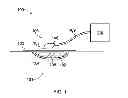 Fig. 02 - Provision of wound filler