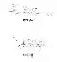 Fig. 09 - Balloon assemblies having controllably variable topographies