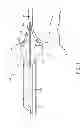 Fig. 02 - Ablation catheter