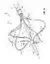 Fig. 07 - Ablation catheter