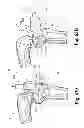 Fig. 45 - Devices and methods for performing knee arthroplasty