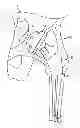 Fig. 01 - Patient-specific femoral version guide