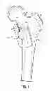 Fig. 02 - Patient-specific femoral version guide
