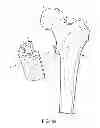 Fig. 04 - Patient-specific femoral version guide