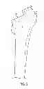 Fig. 05 - Patient-specific femoral version guide