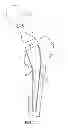 Fig. 06 - Patient-specific femoral version guide