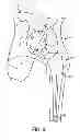 Fig. 09 - Patient-specific femoral version guide