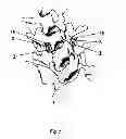 Fig. 08 - Method for locking an artificial facet between two vertebral bodies
