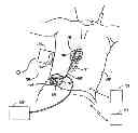 Fig. 01 - Systems and methods for detecting faults and/or adjusting electrical therapy based on impedance changes