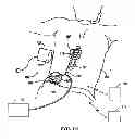 Fig. 02 - Systems and methods for detecting faults and/or adjusting electrical therapy based on impedance changes