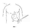 Fig. 02 - Interior needle stick guard stems for tubes