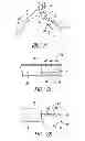 Fig. 05 - Method and apparatus for controlling narrowing of at least one airway