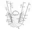Fig. 01 - PEDICLE SUBTRACTION OSTEOTOMY DEVICE AND METHODS