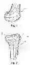 Fig. 02 - Devices and methods for performing knee arthroplasty
