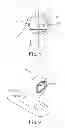 Fig. 05 - SPINAL CORRECTION AND SECONDARY STABILIZATION