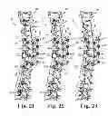 Fig. 11 - SPINAL CORRECTION AND SECONDARY STABILIZATION