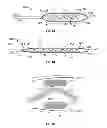 Fig. 02 - Implantable paddle lead comprising stretching electrical traces and method of fabrication