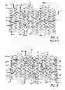 Fig. 04 - ENHANCED RETENTION STENT