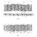 Fig. 16 - Bioabsorbable polymeric medical device