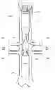 Fig. 01 - Preloaded wire for endoluminal device