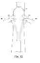 Fig. 13 - Preloaded wire for endoluminal device