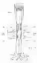 Fig. 30 - Preloaded wire for endoluminal device