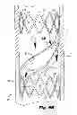 Fig. 07 - Fatigue-resistant flow regulating device and manufacturing methods