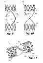 Fig. 12 - Fatigue-resistant flow regulating device and manufacturing methods