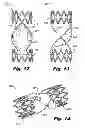 Fig. 13 - Fatigue-resistant flow regulating device and manufacturing methods