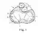 Fig. 02 - Catheter-Based Annuloplasty System and Method