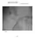 Fig. 22 - PERCUTANEOUSLY DELIVERABLE HEART VALVE AND METHODS ASSOCIATED THEREWITH
