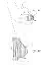 Fig. 03 - HUMAN IMPLANTABLE TISSUE EXPANDER