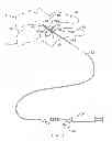 Fig. 03 - Cervical distraction method
