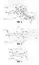 Fig. 04 - Cervical distraction method