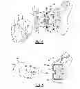 Fig. 04 - Convertible glenoid implant