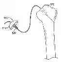 Fig. 01 - Arthroscopic total shoulder arthroplasty