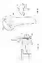 Fig. 02 - Arthroscopic total shoulder arthroplasty