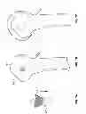 Fig. 06 - Arthroscopic total shoulder arthroplasty